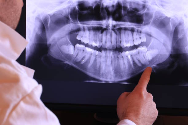 Best Emergency Tooth Extraction in Centralia, WA